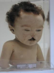 cleft palate baby3